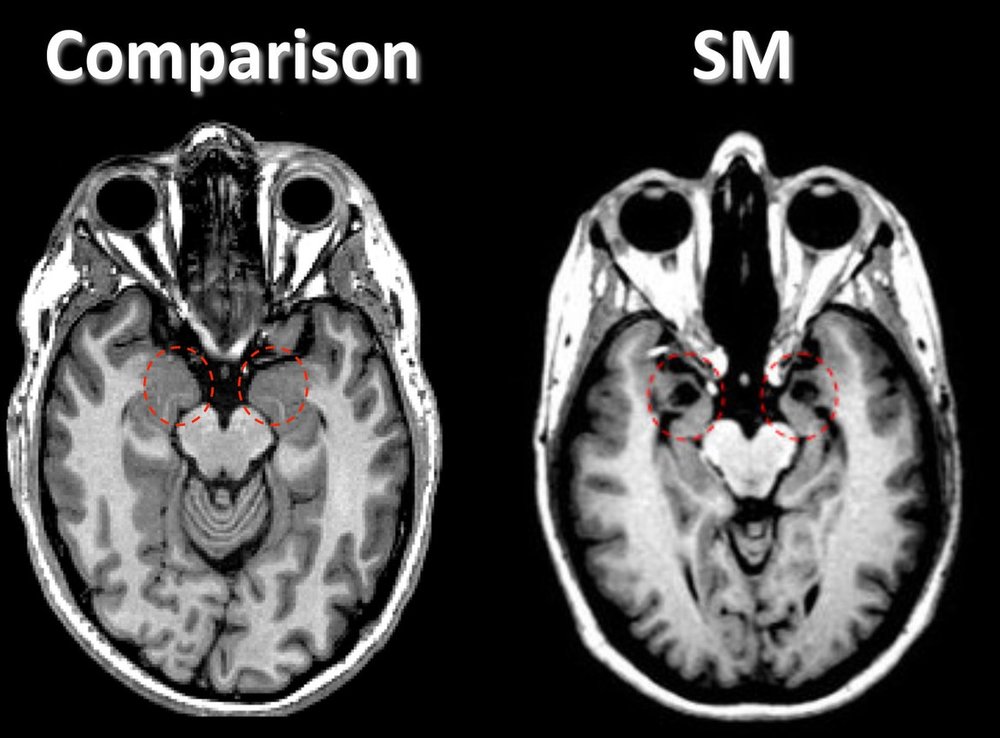 Daily MOS: Mercury Poisoning, The Disease By Three Names. - Scibabe